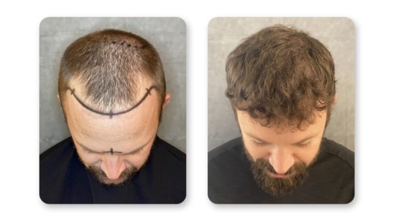 FUE hair transplant results at 12 months — SD Hair MD San Diego