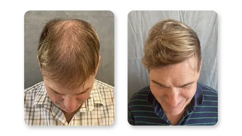 FUE hair transplant results at 12 months — SD Hair MD San Diego