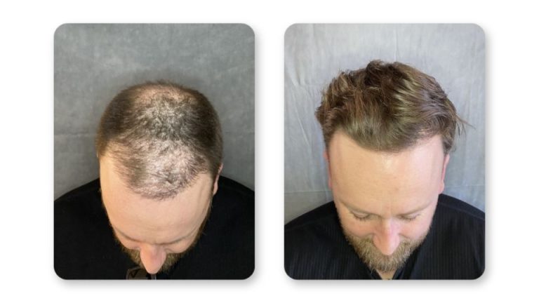 FUE hair transplant results at 6 months patient 3 — SD Hair MD San Diego