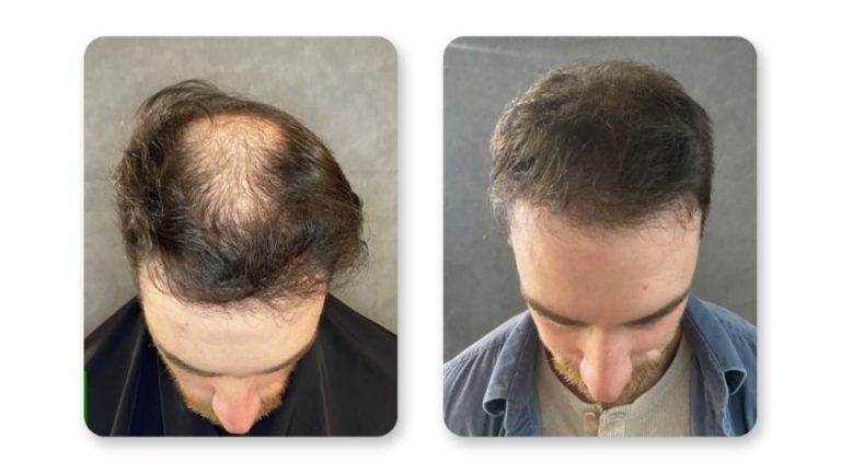 FUE hair transplant results at 6 months patient 5 — SD Hair MD San Diego