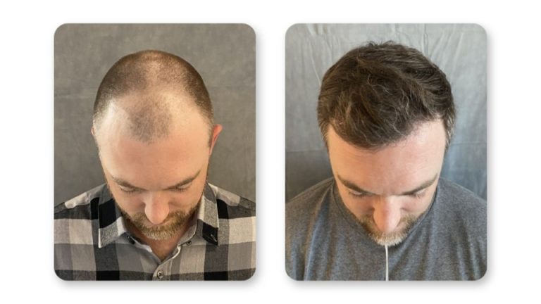 FUE hair transplant results at 6 months patient 6 — SD Hair MD San Diego