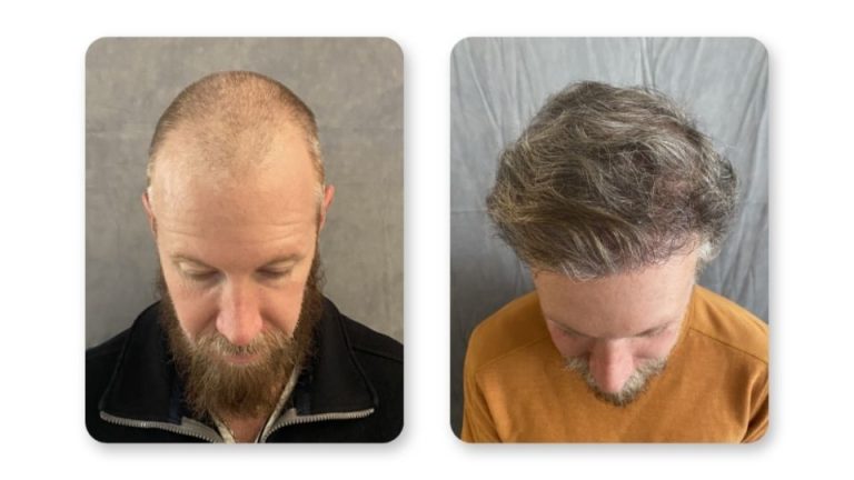 FUE hair transplant results at 7 months aptient 2 — SD Hair MD San Diego