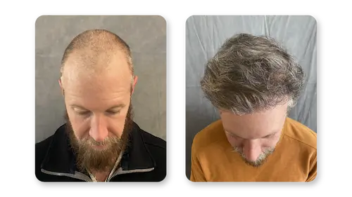 FUE hair transplant results at 7 months patient 2 — SD Hair MD San Diego