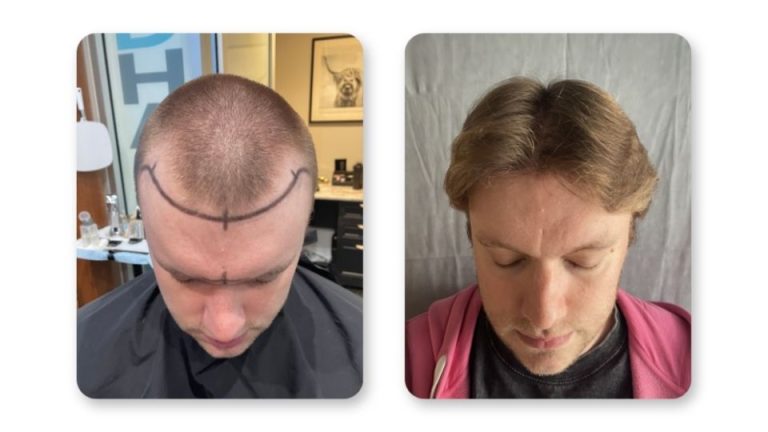 FUE hair transplant results at 9 months patient 3— SD Hair MD San Diego