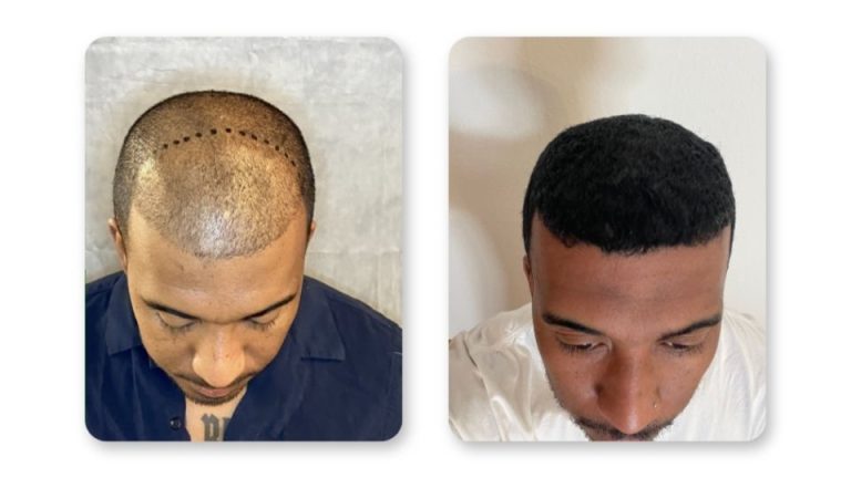 FUE hair transplant results at 9 months patient 4— SD Hair MD San Diego
