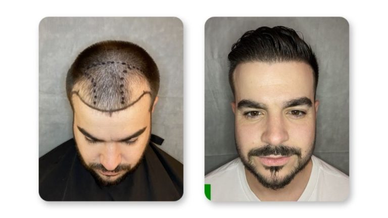 FUE hair transplant results at 9 months patient 5— SD Hair MD San Diego