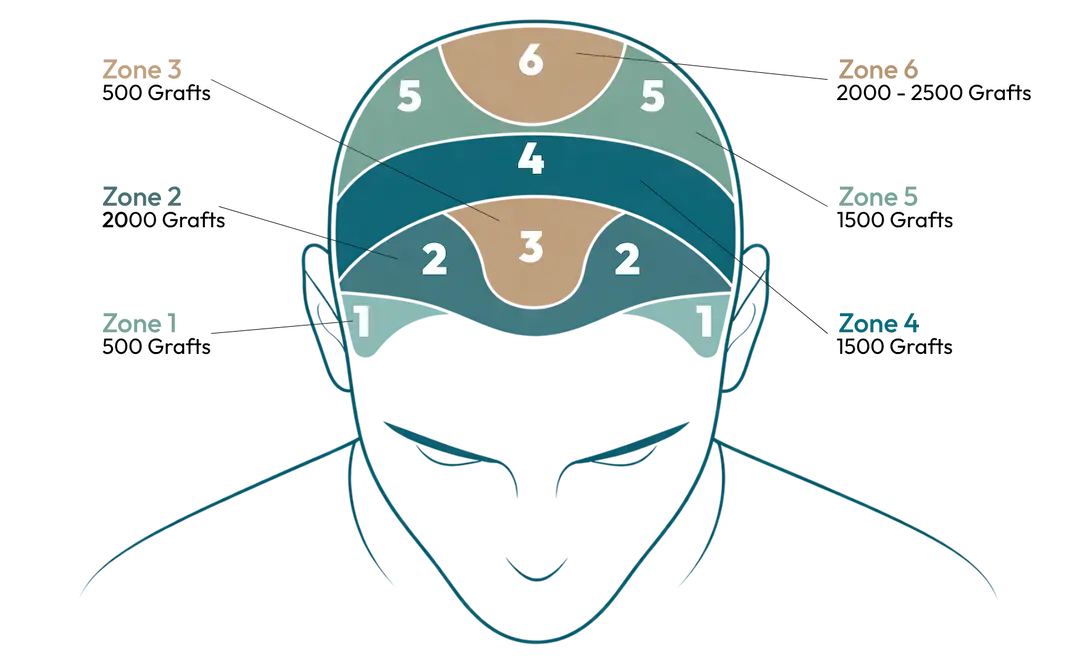 FUE hair transplant process diagram — extract, implant, grow